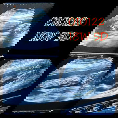 Peneman semasa bersalin