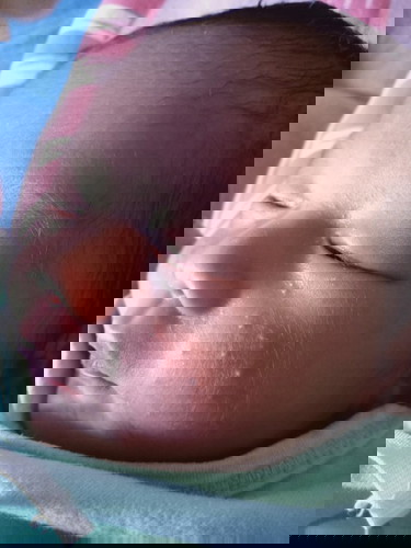 ผื่นขึ้นแบบนี้คือผื่นอะไรคะ แก้ยังไง