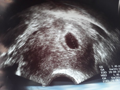 U/S ตอน 5W เจอแต่ถุงการตั้งครรภ์