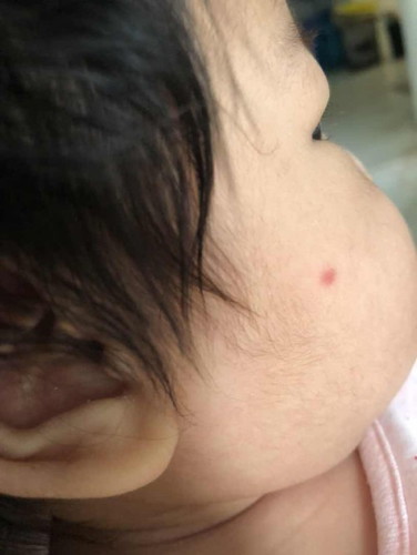 red spot on baby's face