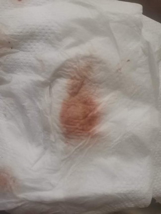Early pregnancy bleeding part 2