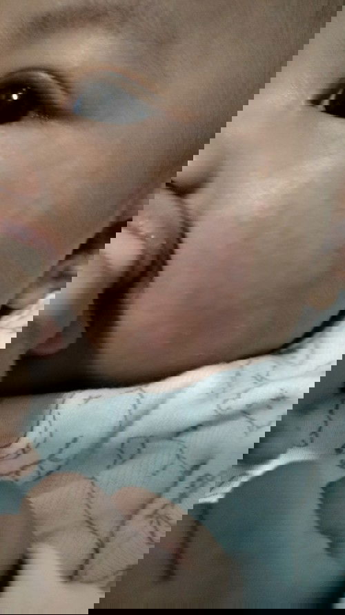 rashes sa mukha ni baby