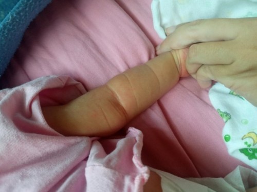 ลูกมีตุ่มขึ้นตามตัวเหมือนยุงกัด เกิดจากอะไรคะ แล้วแบบนี้อันตรายมั้ยคะ