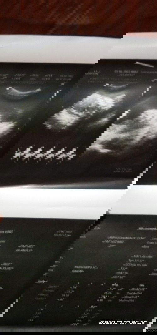 Hi mga momshie, ano po kaya sa tingin ninyo Girl or boy po ba ultrasound ko?