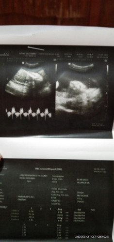 Hi mga momshie, ano po kaya sa tingin ninyo Girl or boy po ba ultrasound ko?