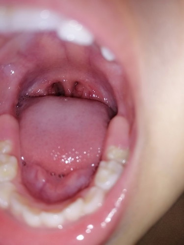 Enlarge Tonsils