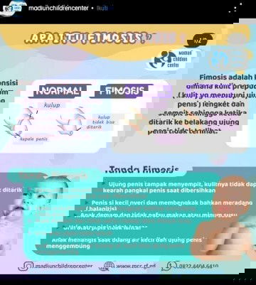 ANAK SAYA FOMOSIS ! yuk bunda kenali apa itu fimosis pada anak laki laki.
