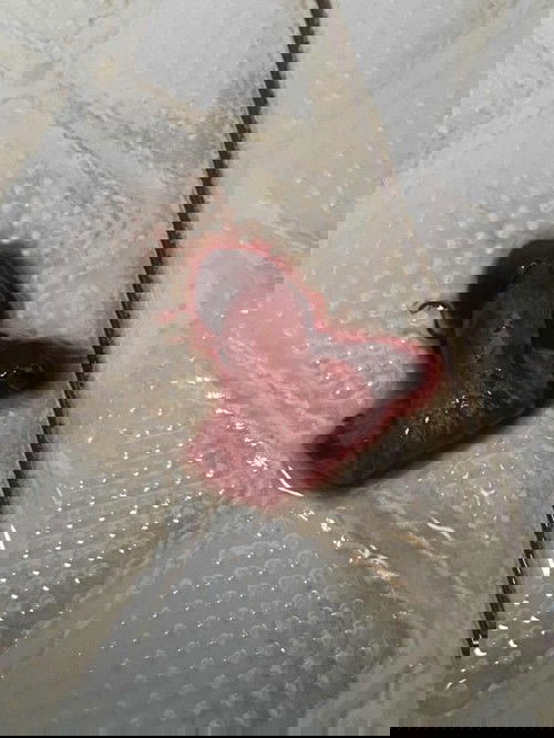 Keguguran 7minggu jalan