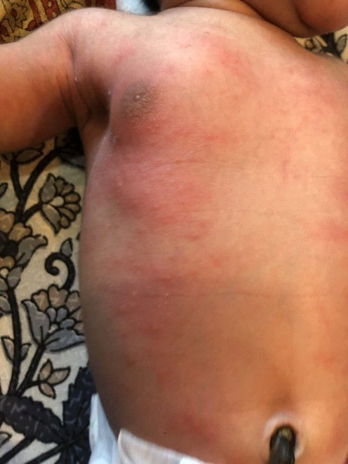Rash on chest