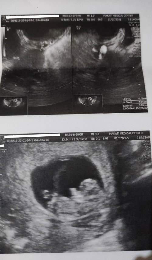 Ultrasound