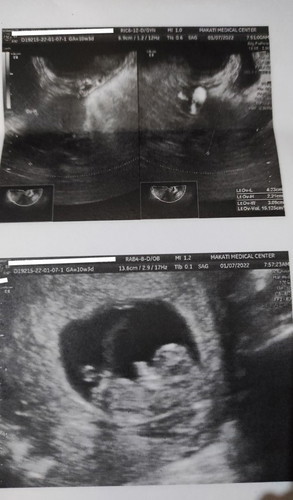 Ultrasound