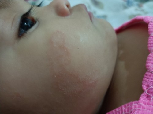 Ano po kaya tong tumubong rashes sa face ng baby ko?