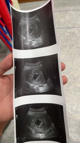 ได้น้องแฝด ต้องดูแลตัวเองยังไง