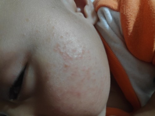 Hello po mga mom pa tulong po kung anu ang dapat ilagay sa rashes ni baby 6 months na po xia salamat