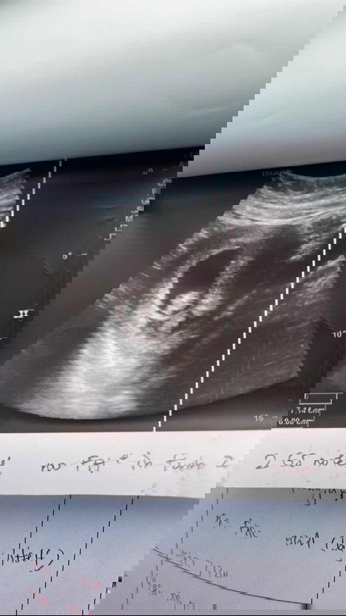 Twin with one hearbeat