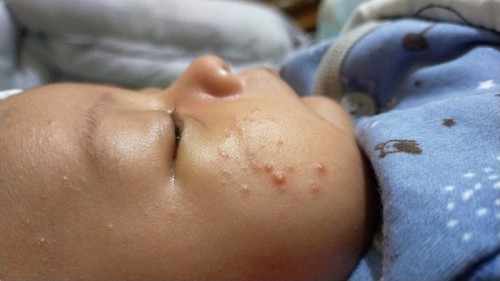 Bruntusan jerawat bayi