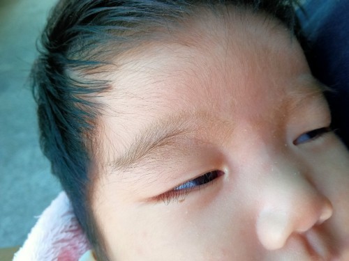 ลูกมีสะเก็ดคล้ายๆไขที่คิ้ว