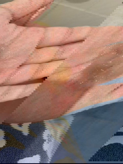 มีมูกแบบนี้ต้องไปหาหมอเลยไหมค่ะ