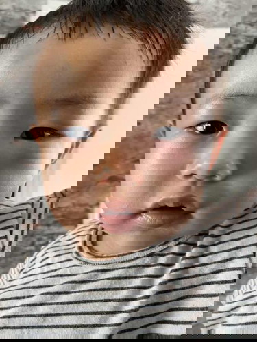 ขอคำปรึกษาหน่อยลูกตาบวม