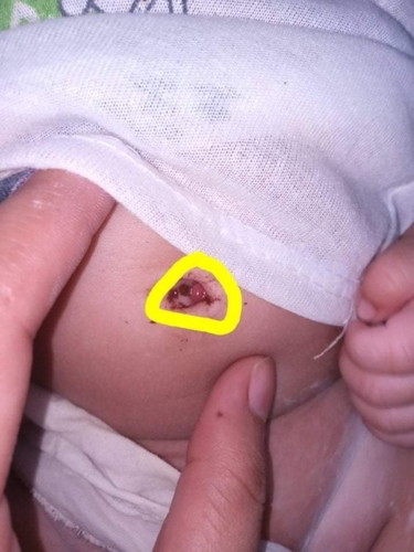 Hindi po ba nakakatakot tong granuloma para sa baby?anu po ginawa sa anak niyo po😞