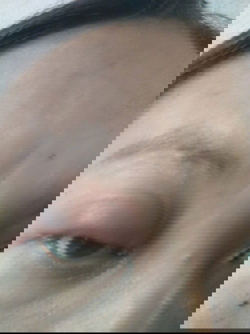 Mata bengkak habis melahirkan