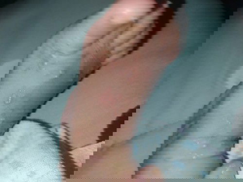 Gatal2 baby usia 2 bln