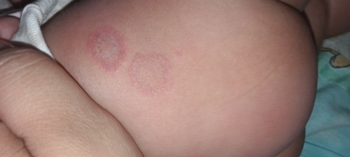 unknown rashes,