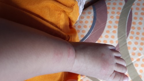 Abis imunisasi polio 1 sama DPT tetes 1 koq muncul bemtol begini ya bun apa itu efeknya apa gimna?