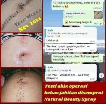 bekas operasi sc