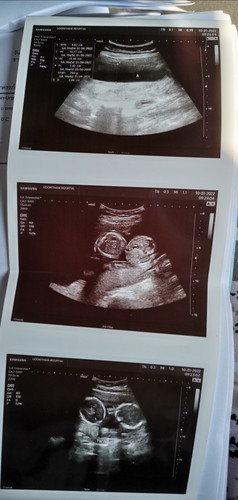 ท้องแฝด.. แต่ถุงเดียวกัน