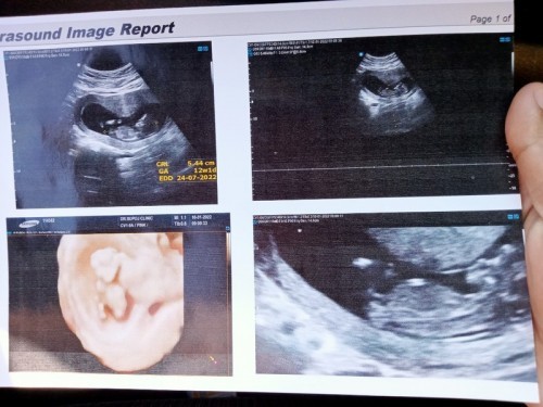 ขอดูภาพซาวด์ของแม่ๆบ้านอื่นหน่อยค่ะ บ้านนี้ 12w 1d  จ้าา😄😄
