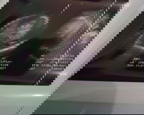 Keakuratan analisa USG jenis kelamin