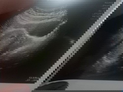 GS : 0.99cm tapi GA : OOR