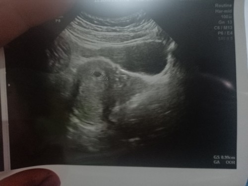 GS : 0.99cm tapi GA : OOR