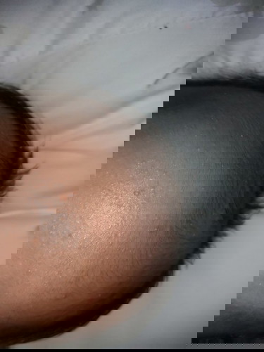 Butlig/Eczema/Craddle Cap