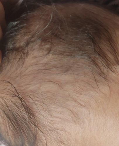 cradle cap