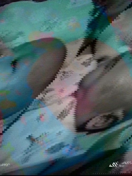 Dermatitis atopik, baby otw 3bulan