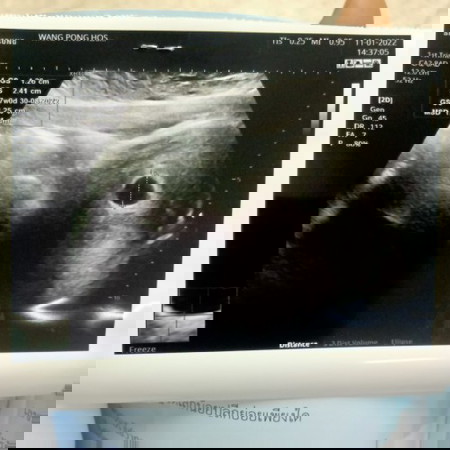 อัลตร้าซาวด์ไม่เจอตัวอ่อน น้อง 7สัปดาห์3วันแล้วค่ะ