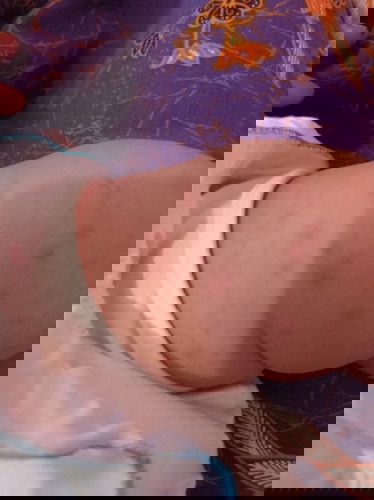 Kulit merah-merah pada bayi