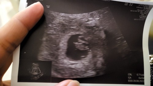 ท่านใดเคยตรวจครั้งแรก เจอหัวใจน้อง และ ครั้งที่สองไม่เจอหัวใจไหมค่ด.. โอกาสทีน้องจะรอดมีไหม