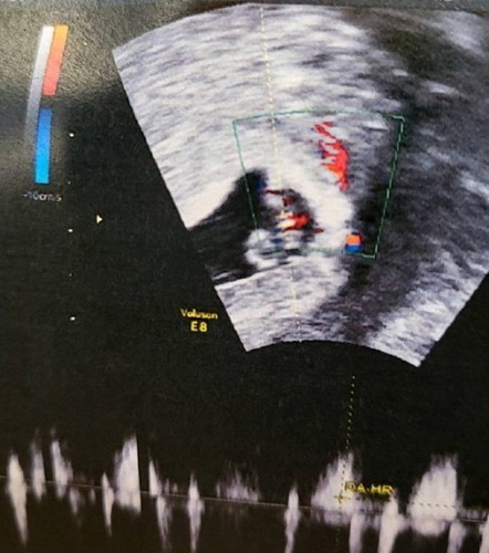 ตั้งครรภ์ได้ประมาณ 6 สัปดาห์ มีเลือดออก