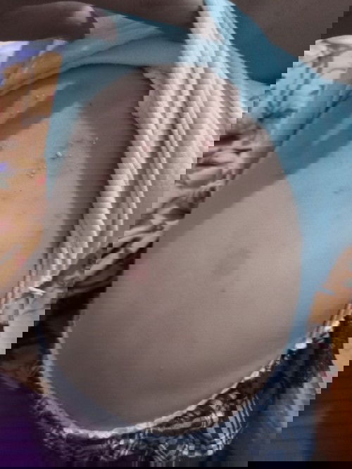 beruntus ada cairan nanah