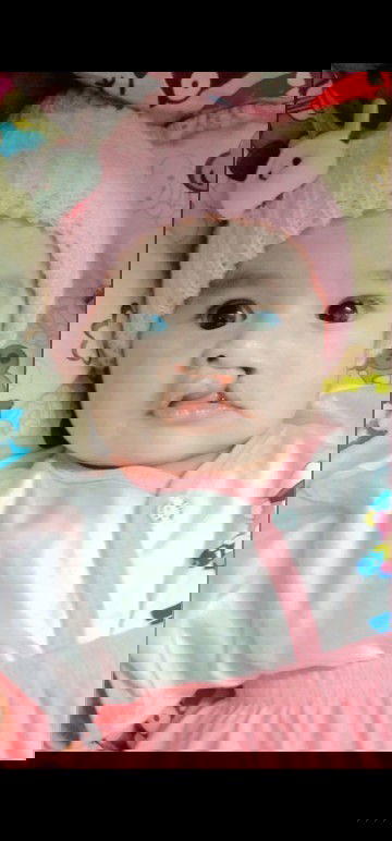 Cleft lip / Sumbing bibir 🤍