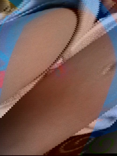 Adakah yg habis imunisasi bcg Brpa bulan yg lalu masih kaya gini  Bun anak saya kok Kya gitu ya Bun