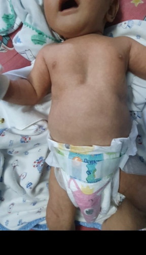 bayi lekuk di dada