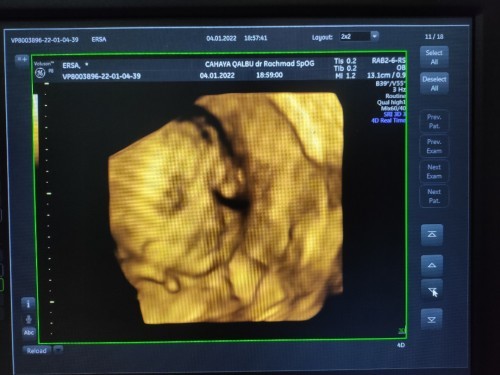 Berat badan janin usia kandungan 29 minggu