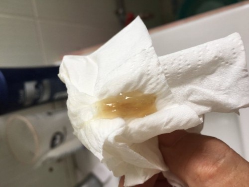 Thai 37 tuần ra dịch nhầy màu trắng đục có phải là dấu hiệu chuyển dạ?