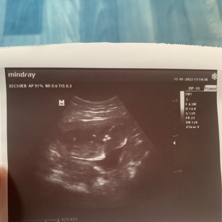Ultrasound