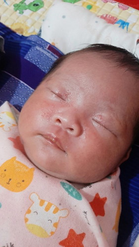 Bintik merah pada wajah bayi