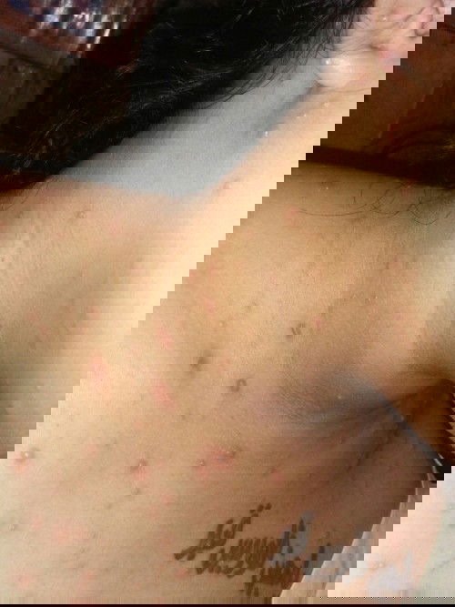 36weeks 
mga mima ano po bang gamot sa bulutong tubig?natatakot po kase ako baka makaapekto sa bbyko